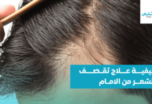 كيفية علاج تقصف الشعر من الأمام