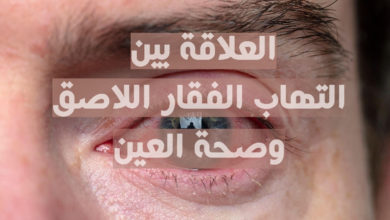 التهاب الفقار اللاصق و صحة العين