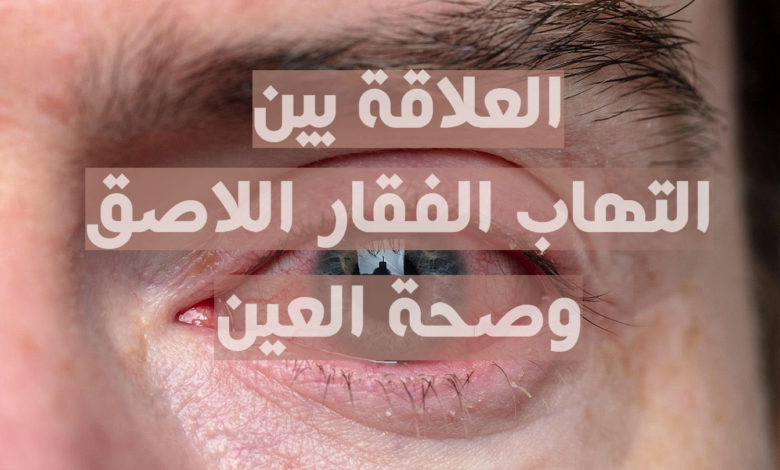 التهاب الفقار اللاصق و صحة العين