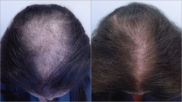 الفرق بين زراعة الشعر للنساء قبل وبعد