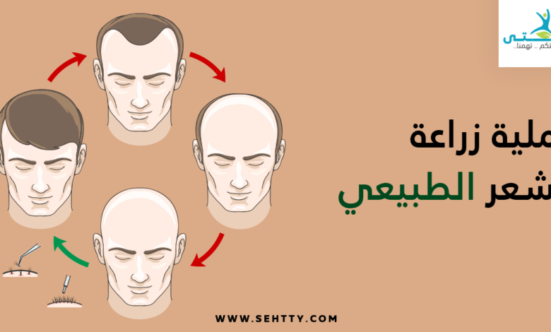 عملية زراعة الشعر الطبيعي