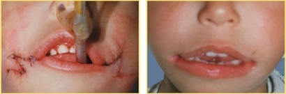 صورة لنتائج عملية تصغير الفم الواسع