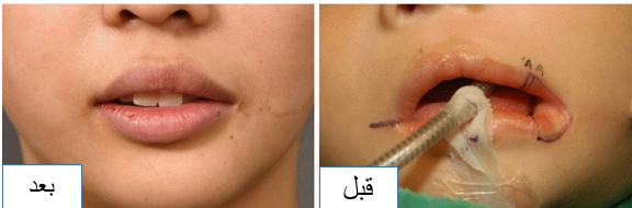 صورة نتائج عملية تصغير الفم الواسع قبل وبعد