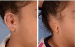 عمليات تجميل الأذن المقطوعة قبل وبعد