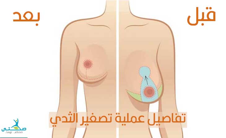 تفاصيل عملية تصغير الثدي