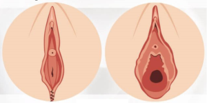 نتيجة عملية ترميم المهبل بعد الولادة قبل وبعد