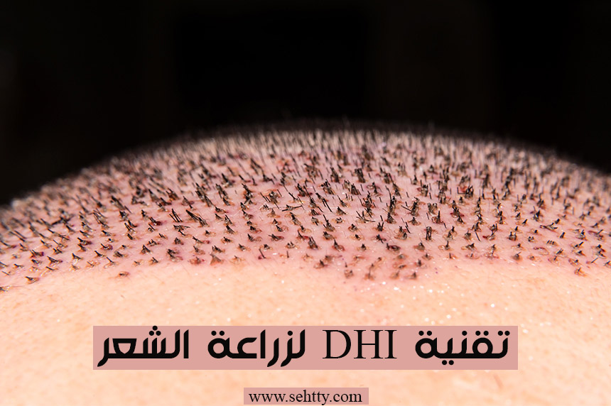 ما هي تقنية DHI لزراعة الشعر 