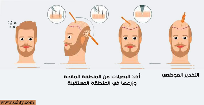 كيف تتم زراعة الشعر بتقنية DHI ؟