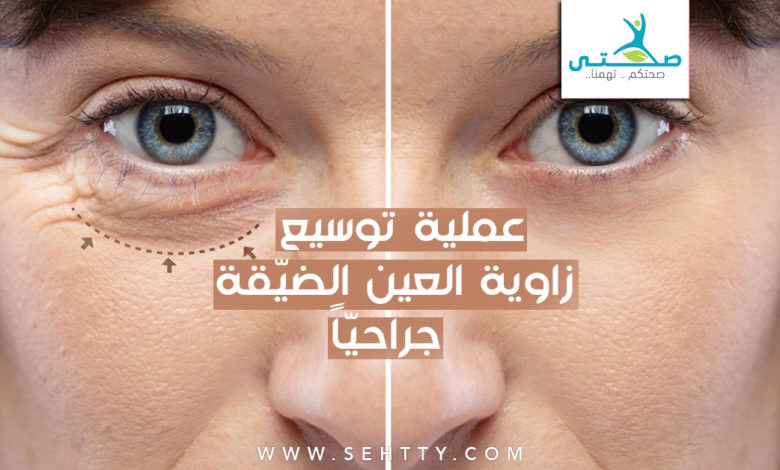 عملية توسيع زاوية العين الضيقة جراحياً